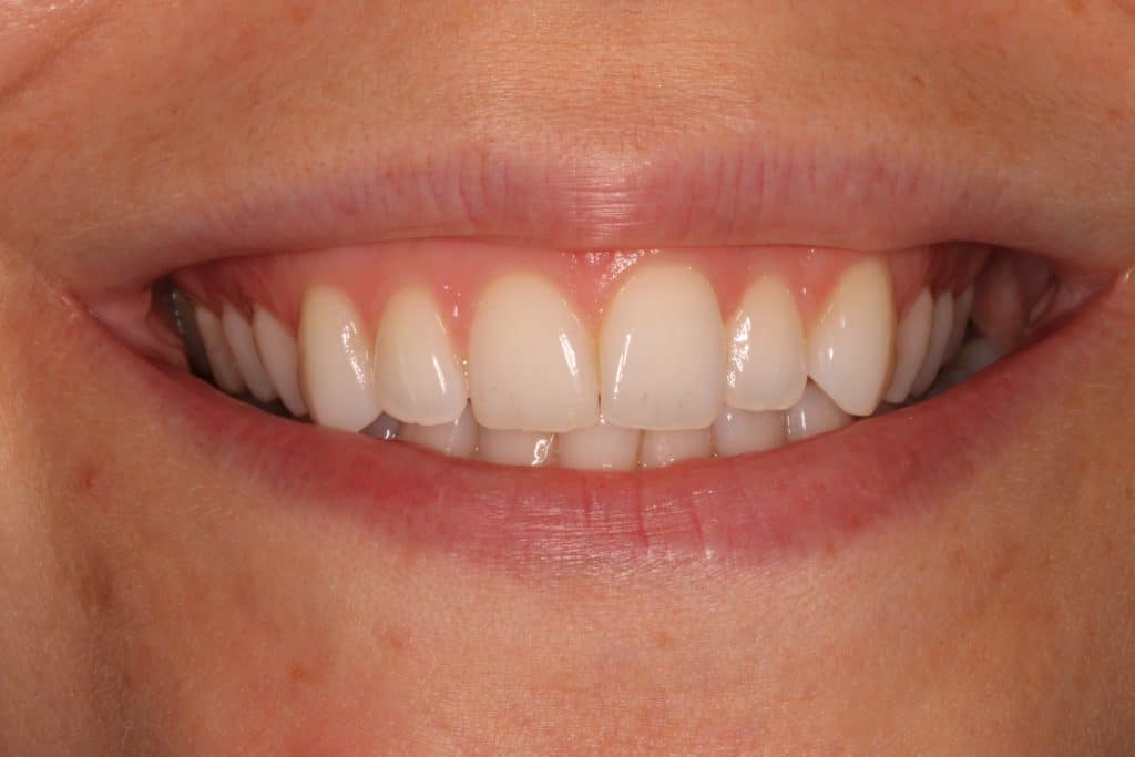a mouth smiling with white straight teeth.